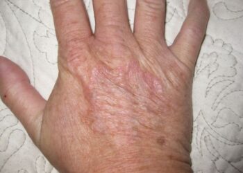Granuloma Annulare Home Remedies