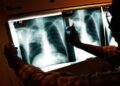 Illegal Immigrant Children With Tuberculosis Released Across US