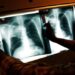 Illegal Immigrant Children With Tuberculosis Released Across US