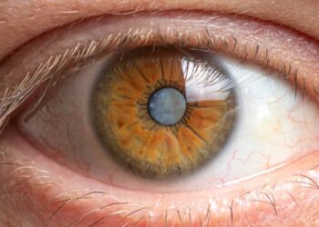 Natural Strategies to Prevent Cataracts