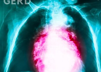 How to Treat GERD Naturally