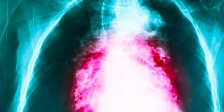 How to Treat GERD Naturally