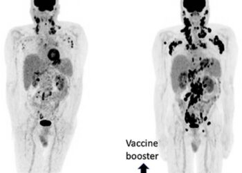 Oncologist and cancer researcher, Dr William Makis, is sounding the alarm on the sudden rise in “turbo cancers”, a recen…