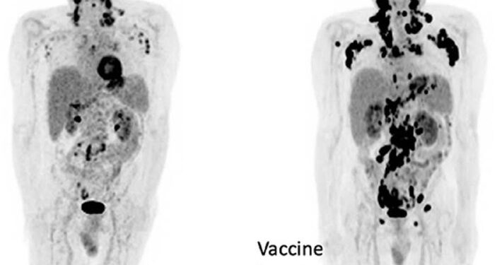 Oncologist and cancer researcher, Dr William Makis, is sounding the alarm on the sudden rise in “turbo cancers”, a recen…
