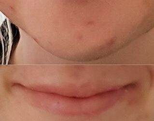 Natural Remedies for Staph Infections