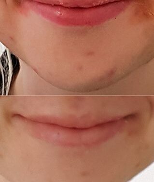 Natural Remedies for Staph Infections